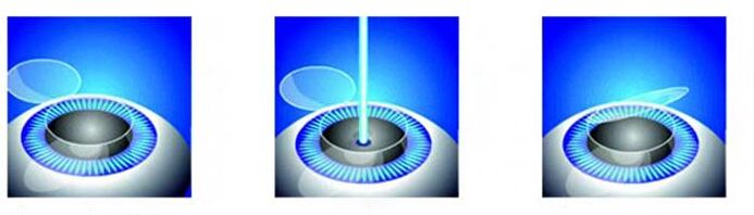 Phase de correction de la vision laser