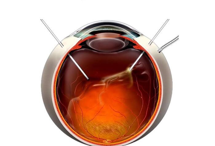 Vitranctomie une opération pour restaurer la vision